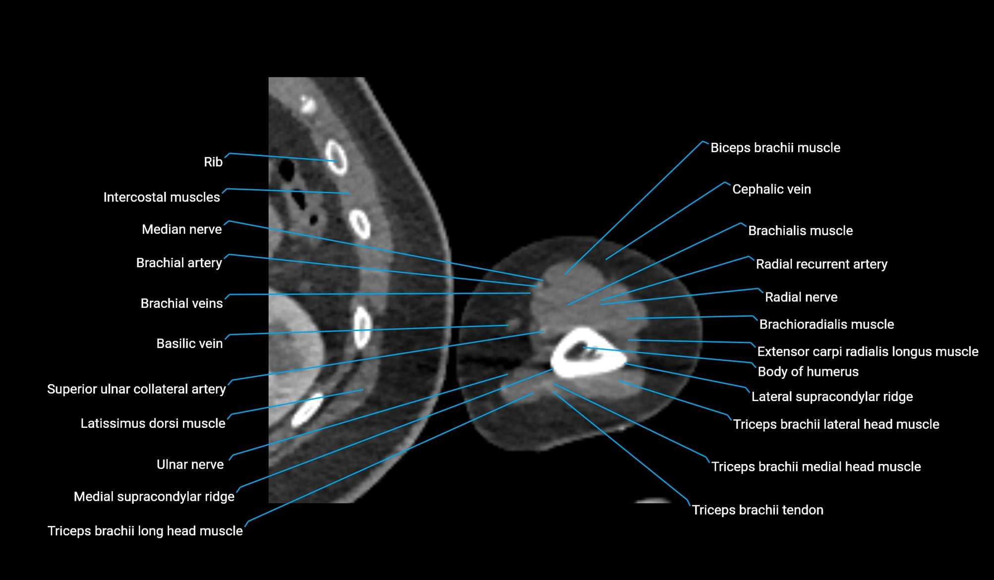 CT upper arm axial  cross sectional anatomy labelled radiology image -00346.webp